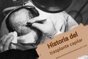 Historia del trasplante capilar,