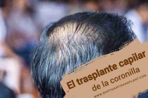 El trasplante capilar de la coronilla,