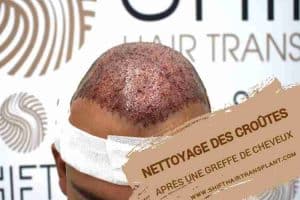 Nettoyage des croûtes après la greffe de cheveux, Une photo d'un patient prise immédiatement après une greffe de cheveux et des croûtes est si fraîche.