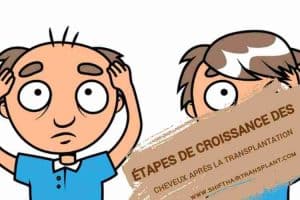 Étapes de croissance des cheveux après la greffe, Image d'animation pour un vieil homme avant et après une greffe de cheveux.