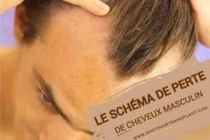 Le schéma de perte de cheveux masculin, Un homme avec la perte de cheveux de modèle masculin.