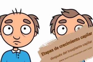 Etapas de crecimiento capilar después del trasplante capilar, Imagen de animación para un anciano antes y después del trasplante de cabello.