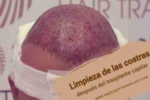 Limpieza de las costras después del trasplante capilar, Una foto de un paciente tomada inmediatamente después del trasplante de cabello y las costras son muy recientes.