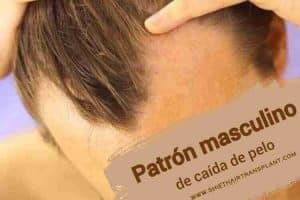 Patrón masculino de caída de pelo, Calvicie de patrón masculino, un hombre con pérdida de cabello de patrón masculino.