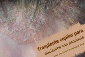 Trasplante capilar para pacientes con psoriasis, imagen principal del artículo del blog.