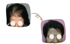 una mujer antes y después del trasplante de cabello para mujeres en Estambul por SHIFT Hair Transplant Clinic en Estambul