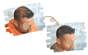 un homme avant et après afro la greffe de cheveux à Istanbul en Turquie avec SHIFT Hair Transplant