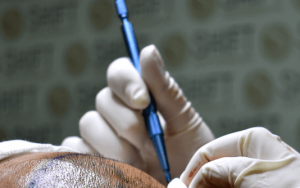 Sapphire FUE, un derivado del trasplante de cabello FUE en Shift Hair Transplant en Estambul, Turquía