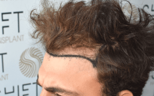 Greffe de cheveux FUE par SHIFT Greffe de cheveux à Istanbul