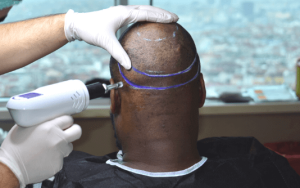 Greffe de cheveux en or par SHIFT Greffe de cheveux à Istanbul