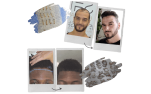 Trasplante de cabello afro en Turquía por SHIFT Hair Transplant Istanbul