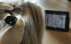 Micro greffe de cheveux FUE en Turquie avec greffe de cheveux Shift à Istanbul Turquie
