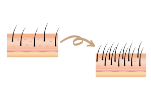Micropigmentation du cuir chevelu Turquie dans la clinique SHIFT