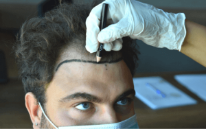 Greffe de cheveux pour hommes en Turquie par SHIFT Hair Transplant Clinic Istanbul