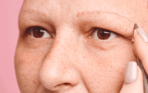 Greffe de sourcils en Turquie avec greffe de cheveux Shift à Istanbul Turquie