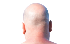 Micropigmentation du cuir chevelu Istanbul par SHIFT Turquie