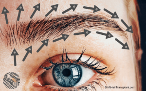 Greffe de sourcils en Turquie avec greffe de cheveux Shift à Istanbul Turquie