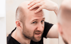 Les avantages de la greffe de cheveux FUE en Turquie avec SHIFT Istanbul