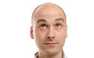 un hombre está levantando las cejas para una evaluación en línea de trasplante de cabello con trasplante de cabello por turnos en Estambul, Turquía