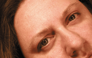 Trasplante de cejas en Turquía con trasplante de cabello por turnos en Estambul Turquía