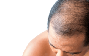 Los beneficios del trasplante de cabello DHI en Turquía Estambul con SHIFT