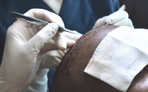 Micro FUE, un derivado del trasplante de cabello FUE en Shift Hair Transplant en Estambul, Turquía