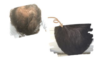 avant et après Hair PRP à Istanbul en Turquie avec Shift Hair Transplant à Istanbul en Turquie