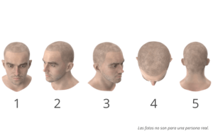 Las posiciones óptimas para una evaluación más precisa con Shift Hair Transplant en Estambul, Turquía