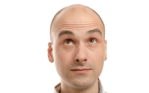 un homme lève les sourcils pour une évaluation en ligne d'une greffe de cheveux avec une greffe de cheveux Shift à Istanbul en Turquie