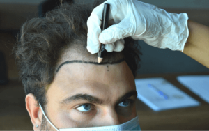 Trasplante de cabello para hombres en Turquía por SHIFT Hair Transplant Clinic Istanbul