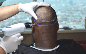 Trasplante de cabello sin aguja de SHIFT Hair Transplant en Estambul