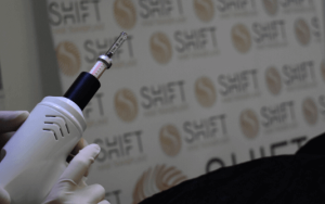 Trasplante de cabello sin aguja de SHIFT Hair Transplant en Estambul