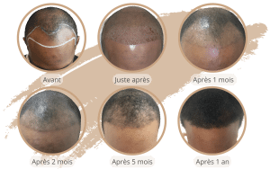 La chronologie de la croissance d'Afro Transplant en Turquie avec SHIFT à Istanbul 3