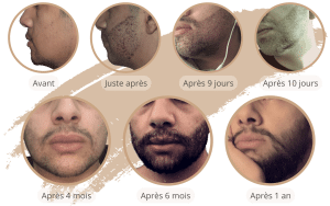 La chronologie de la croissance de la greffe de barbe en Turquie avec SHIFT à Istanbul 3