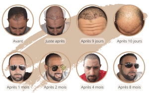 La chronologie de la croissance de la greffe de cheveux en Turquie avec SHIFT à Istanbul 3