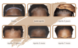 La chronologie de la croissance de la greffe de cheveux pour les femmes en Turquie avec SHIFT à Istanbul 3