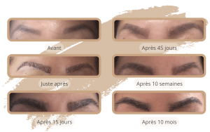 La chronologie de la croissance de la greffe de sourcils en Turquie avec SHIFT Greffe de Cheveux à Istanbul 1