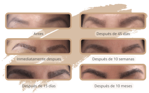 La cronología del crecimiento del trasplante de cejas en Turquía con SHIFT Trasplante Capilar en Estambul 1