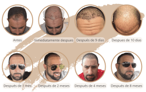 La línea de tiempo de crecimiento del trasplante de cabello en Turquía con SHIFT en Estambul 3