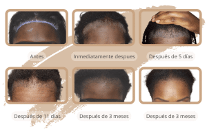 La línea de tiempo de crecimiento del trasplante de cabello para mujeres en Turquía con SHIFT en Estambul 3