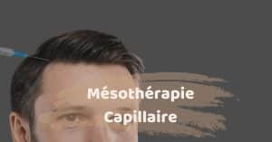 Mésothérapie Capillaire en Turquie avec SHIFT Greffe de Cheveux à Istanbul 1
