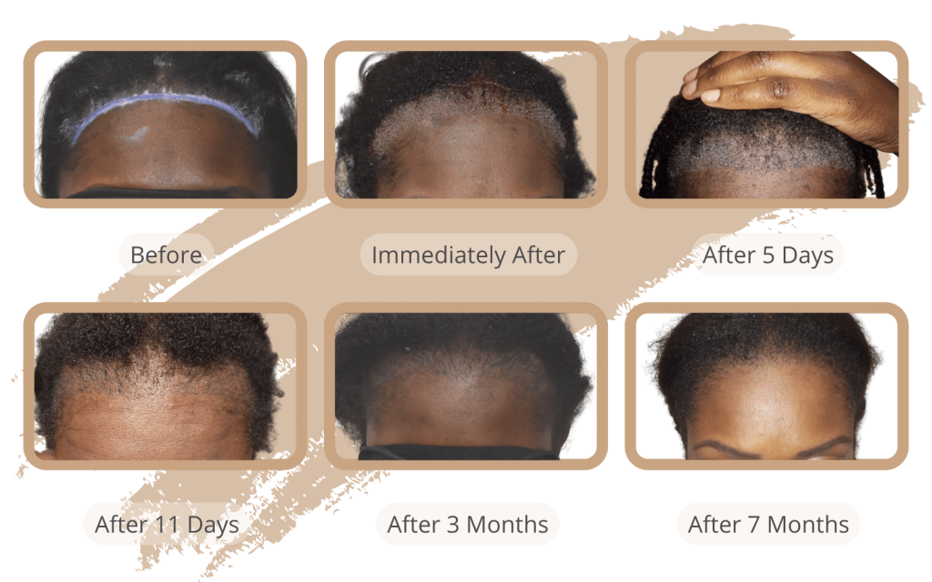 Womens Best Hair Transplant Services in New Area Ludhiana  Ask Me Style Hair  Transplant Centre