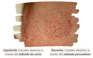 La diferencia entre la hendidura y los métodos percutáneos en la apertura de los microcanales con SHIFT 3