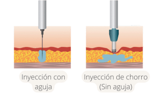 La diferencia entre las inyecciones con aguja y las inyecciones Jet en Estambul 3