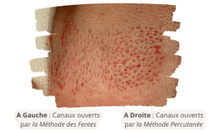 La différence entre les méthodes de fente et percutanée dans la greffe de cheveux avec SHIFT 3