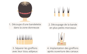 Le processus de greffe de cheveux FUT en Turquie 3