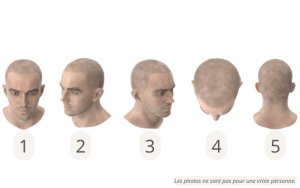 Les positions de tête pour une consultation de micropigmentation du cuir chevelu en ligne avec SHIFT 1