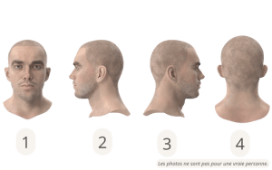 Les positions de tête pour une consultation en ligne de greffe de barbe en Turquie 1