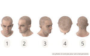 Les positions de tête pour une consultation en ligne de greffe de cheveux en Turquie 1