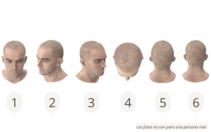 Posiciones de la cabeza para un soporte para el cabello en línea SHIFT Trasplante Capilar 1